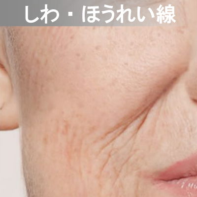 Eライト対応メニュー しわ・ほうれい線