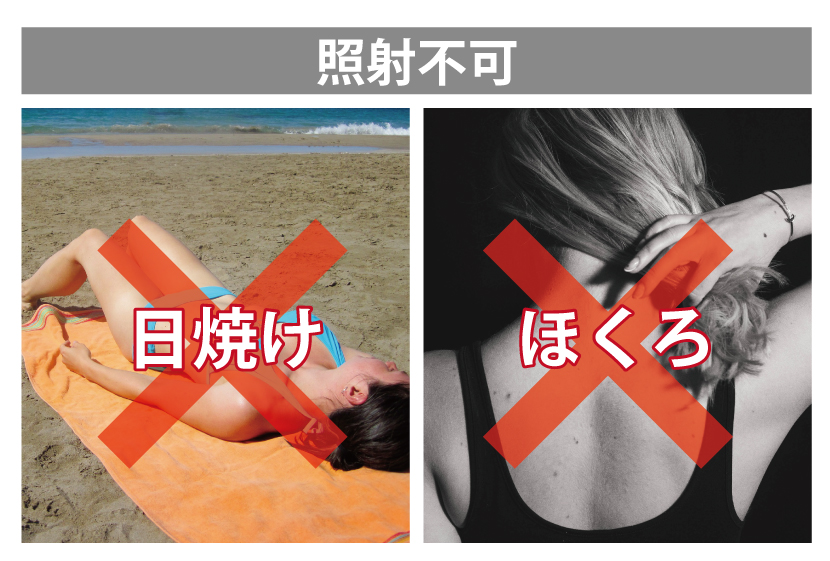 IPL脱毛照射不可な箇所