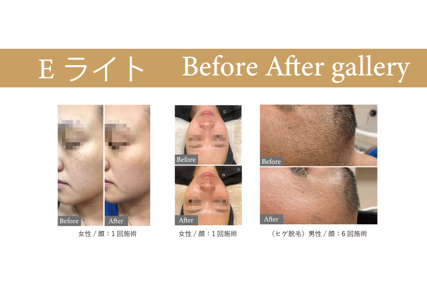 ペガサスプロで施術したEライトビフォアアフター