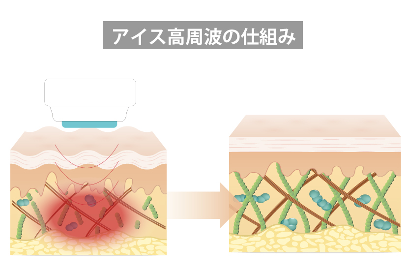 アイス高周波の仕組み