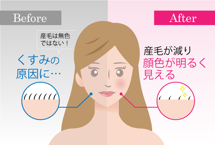 顔脱毛の効果-トーンアップする