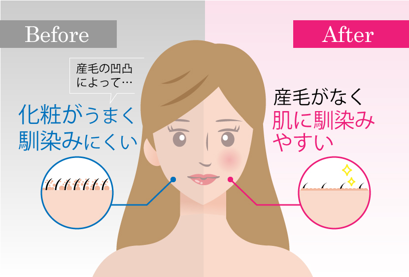 顔脱毛の効果-化粧馴染みが良い