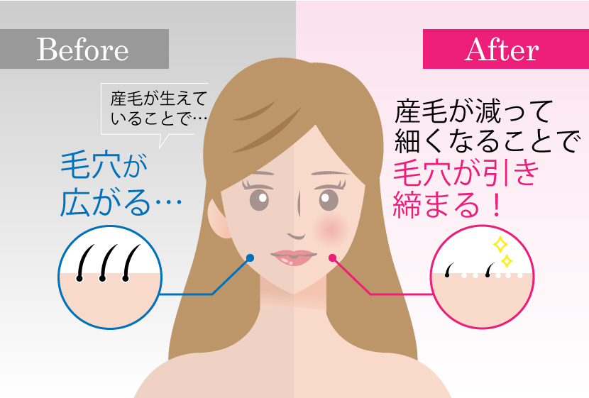 顔脱毛の効果-毛穴引き締め