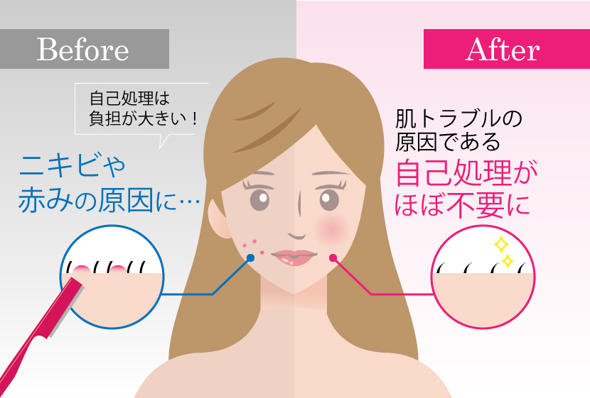 顔脱毛の効果-肌トラブル防止