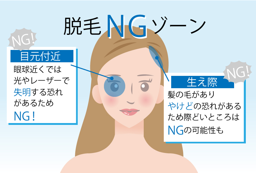 顔脱毛施術NGゾーン
