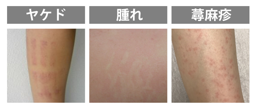 火傷-腫れ-蕁麻の疹患部症例
