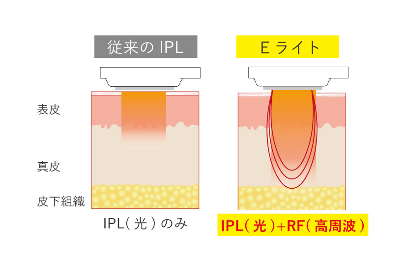 Eライトの仕組み