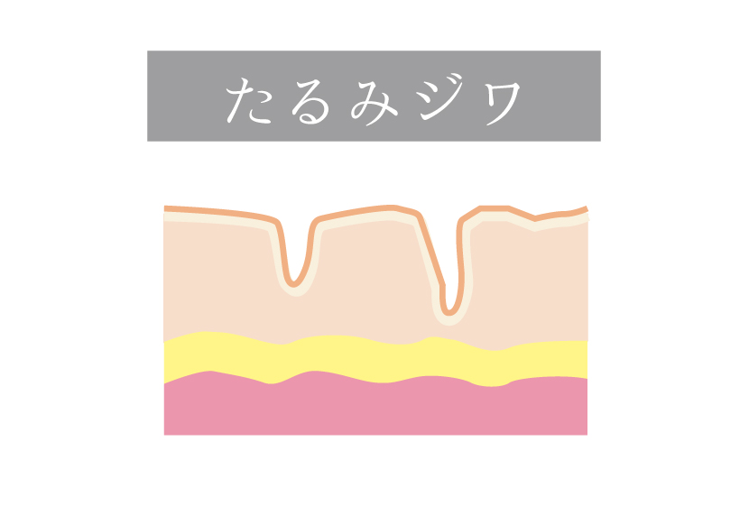 たるみジワ