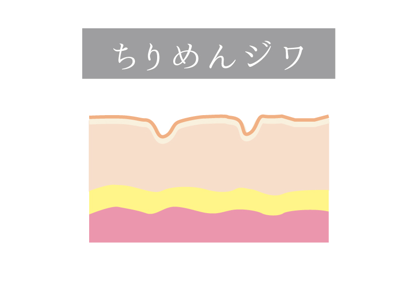 ちりめんジワ