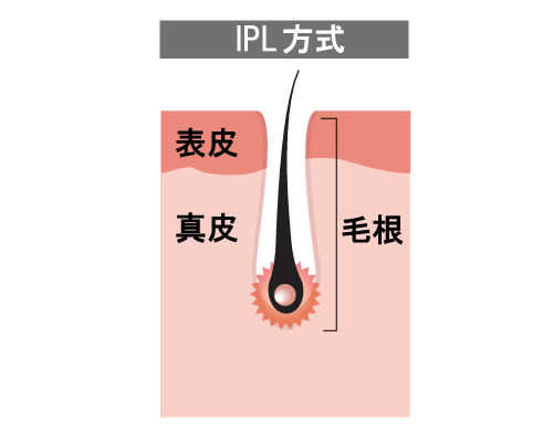 IPL方式図解